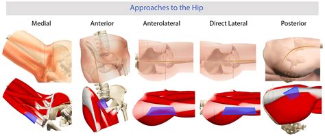 total hip replacement steps orthobullets|Surgical Approaches for Total Hip Arthroplasty. .